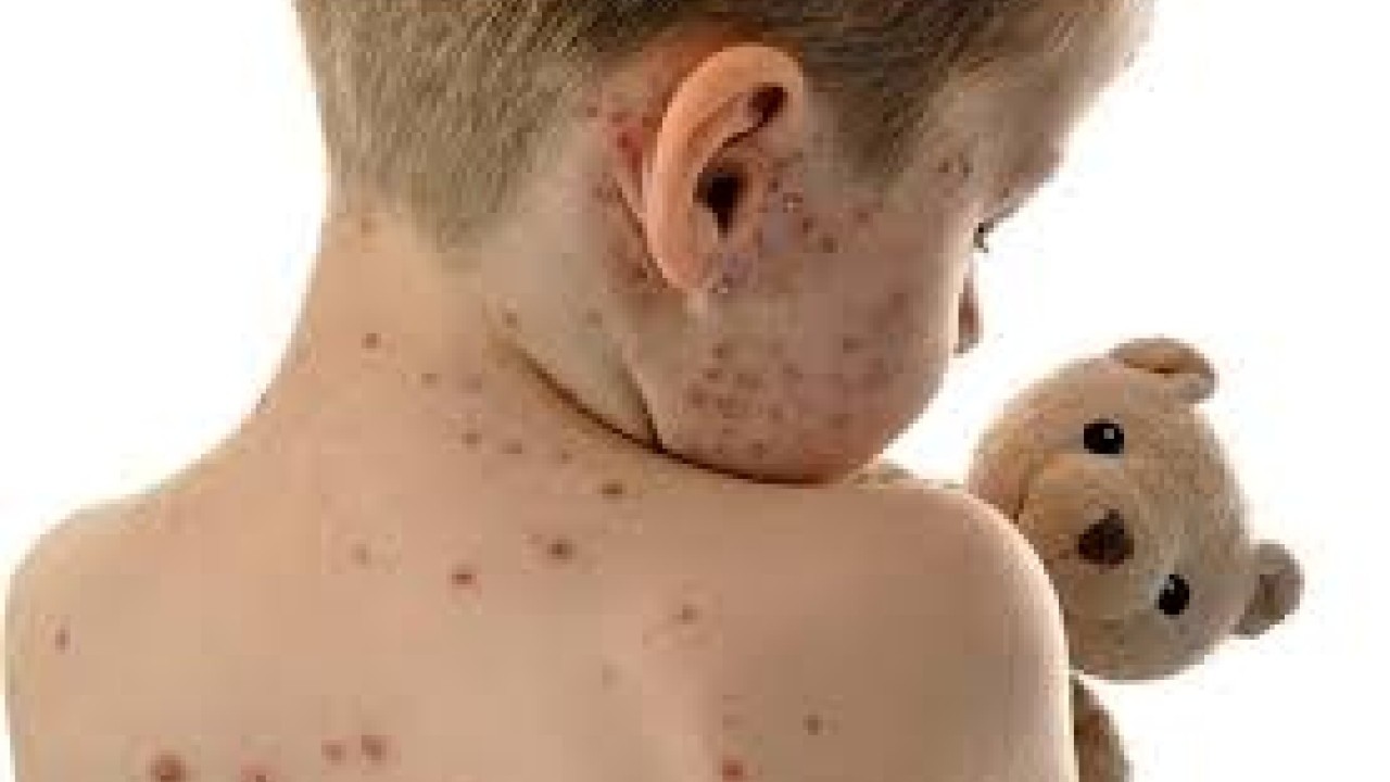 Uşaqlar arasında suçiçəyi xəstəliyi yayılıb - VİDEO